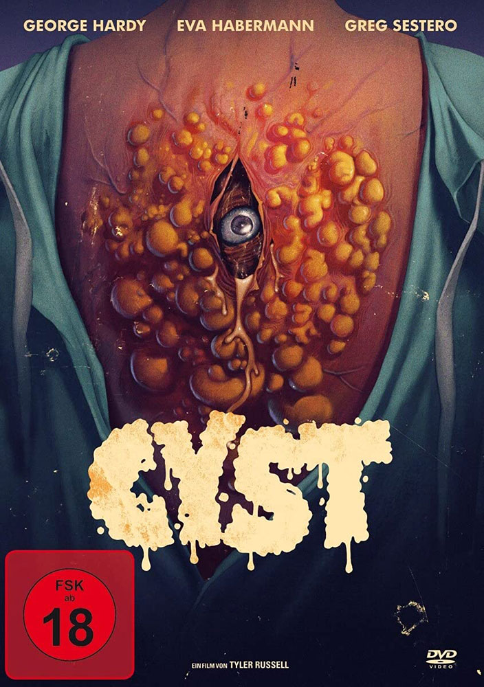 Cyst - Uncut Cyst - Uncut